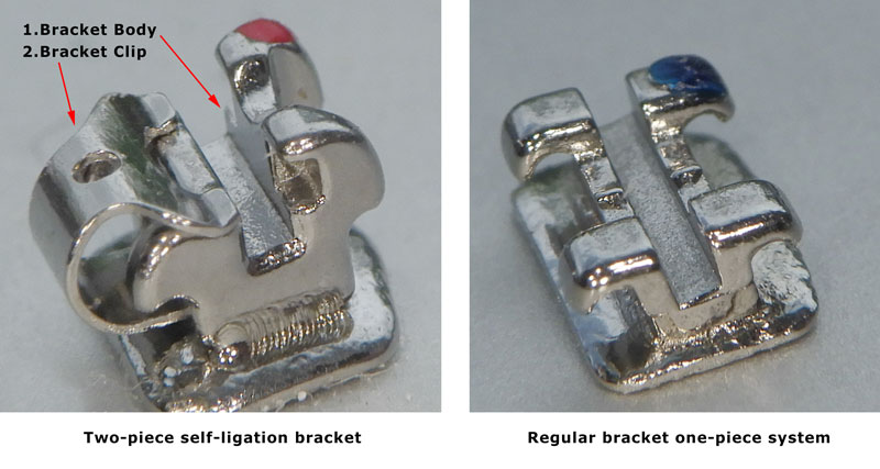 Self ligating bracket comparison with traditional metal braces