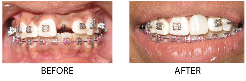 Dental Implant Temporary Case