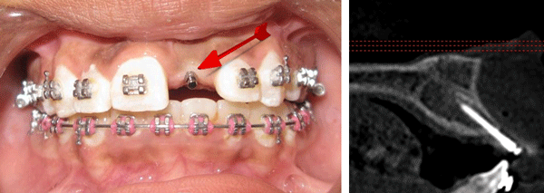 IOS Best Temporary dental Implant