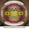 perfect method to get a dry field Tongue block and retractor