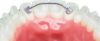 Picture of Lingual Retainers 2&2 18 mm - PK/2