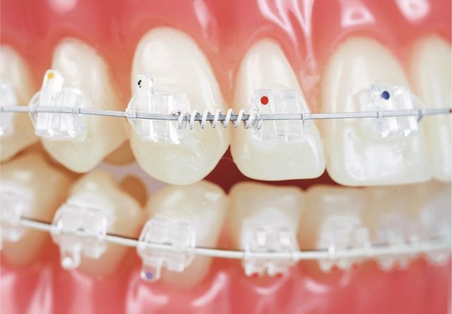 IOS Ortho. Tooth Colored Open Coil NiTi